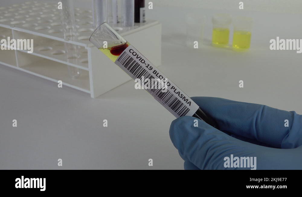 Blood plasma sample Covid19 patient, coronavirus antibody levels