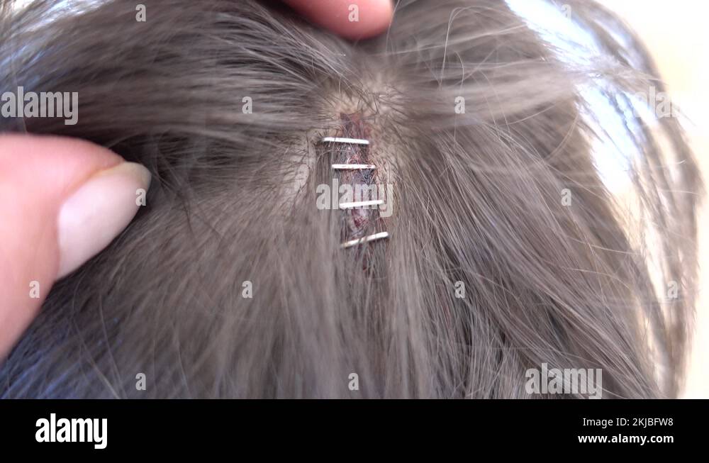 Open head injury Stock Videos & Footage HD and 4K Video Clips Alamy