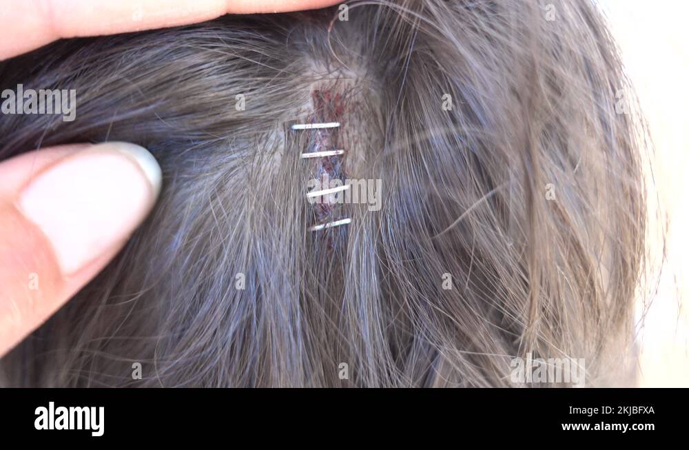 Surgical staples Stock Videos & Footage HD and 4K Video Clips Alamy