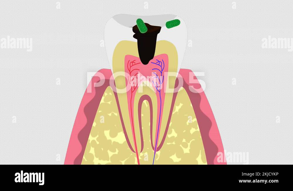 Causes of tooth cysts 4K, alpha channal Stock Video Footage Alamy