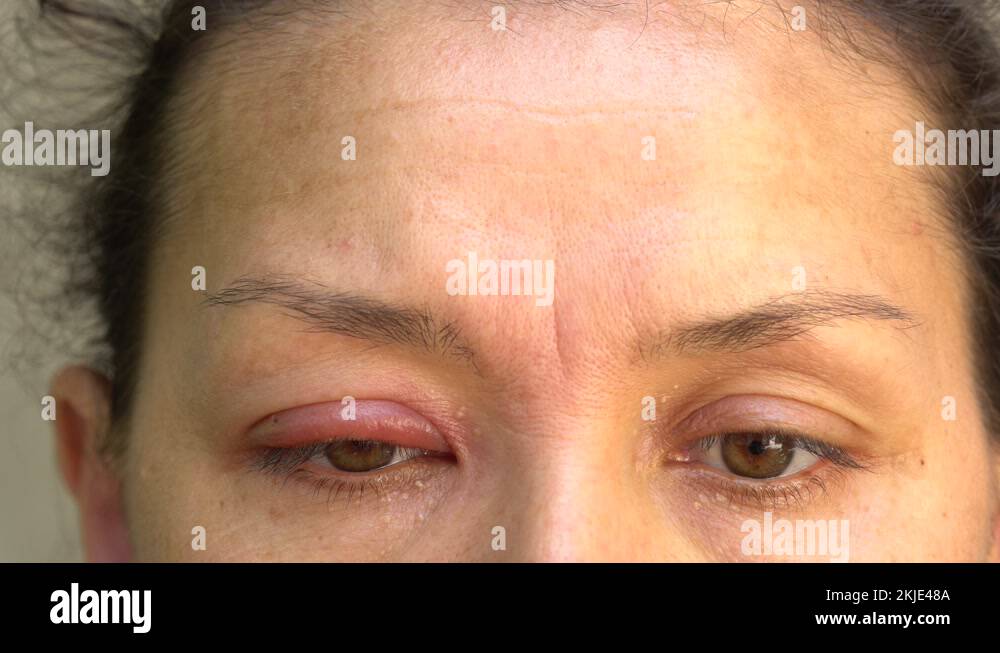 Hair follicle infection Stock Videos & Footage HD and 4K Video Clips