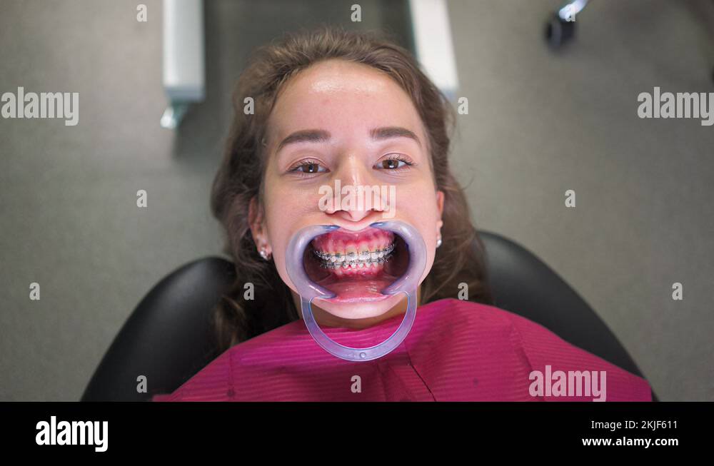 Woman Patient with Retractor Mouth with Braces Dental Office Lies Hospital Bed Stock Video