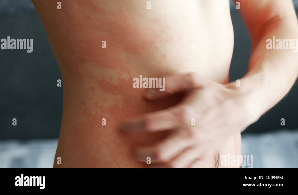 Man scratches a red rash on his neck. Allergies and skin diseases Stock