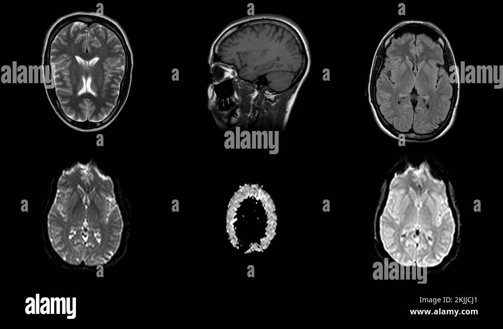 Time lapse of MRI brain scan set, timelapse resonance imaging
