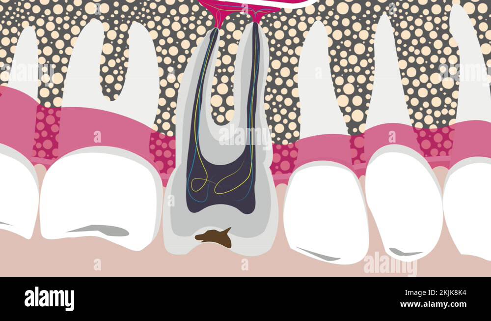 Inflammation of the pulp of the tooth, dental caries, 4K Stock Video