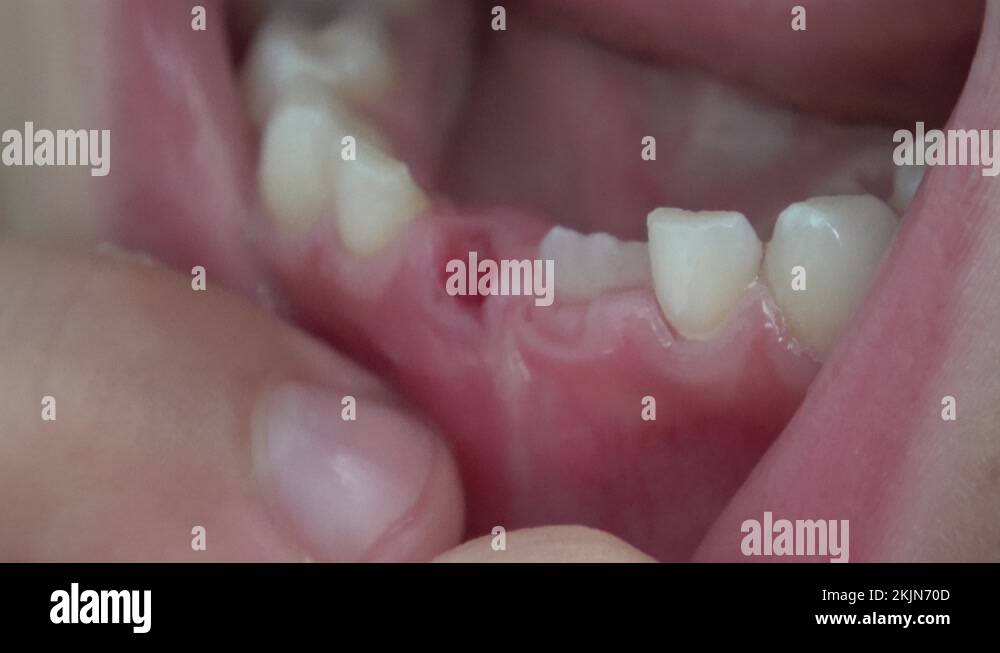 Teeth are falling out Stock Videos & Footage - HD and 4K Video Clips