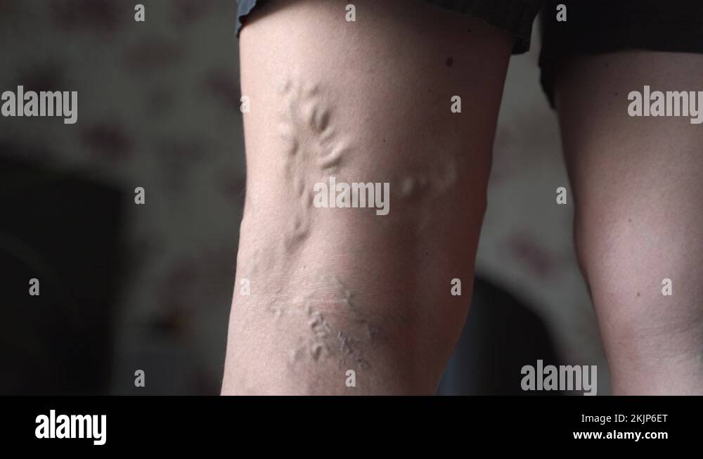 Varicose veins on woman legs indoors. Vascular health problem. Trombose