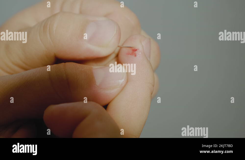 Method for selfremoval of warts. Wart Removale Procedure using a