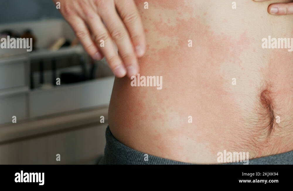 Man scratches a red rash on his neck. Allergies and skin diseases Stock