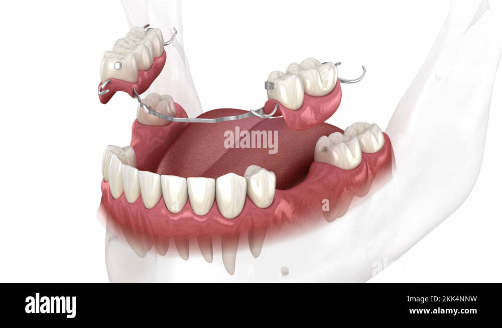 Removable partial denture, mandibular prosthesis Stock Video Footage Alamy