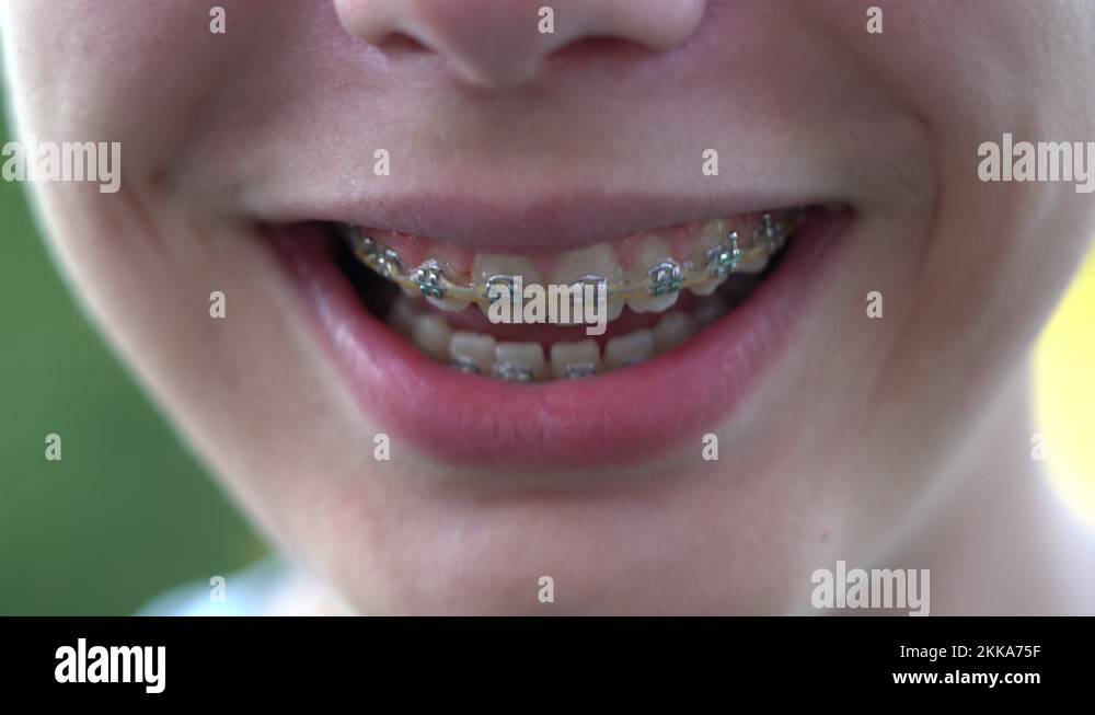 Smiling mouth of young white kid with overbite teeth wearing fixing