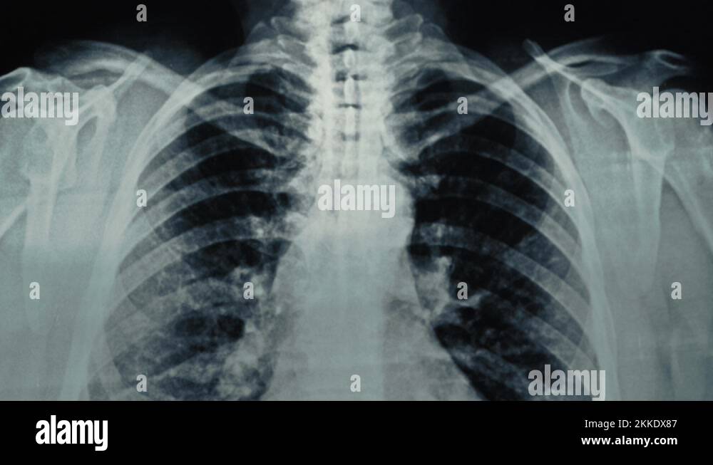 Doctor hand shows areas of affected lungs on chest xray film. Asthma