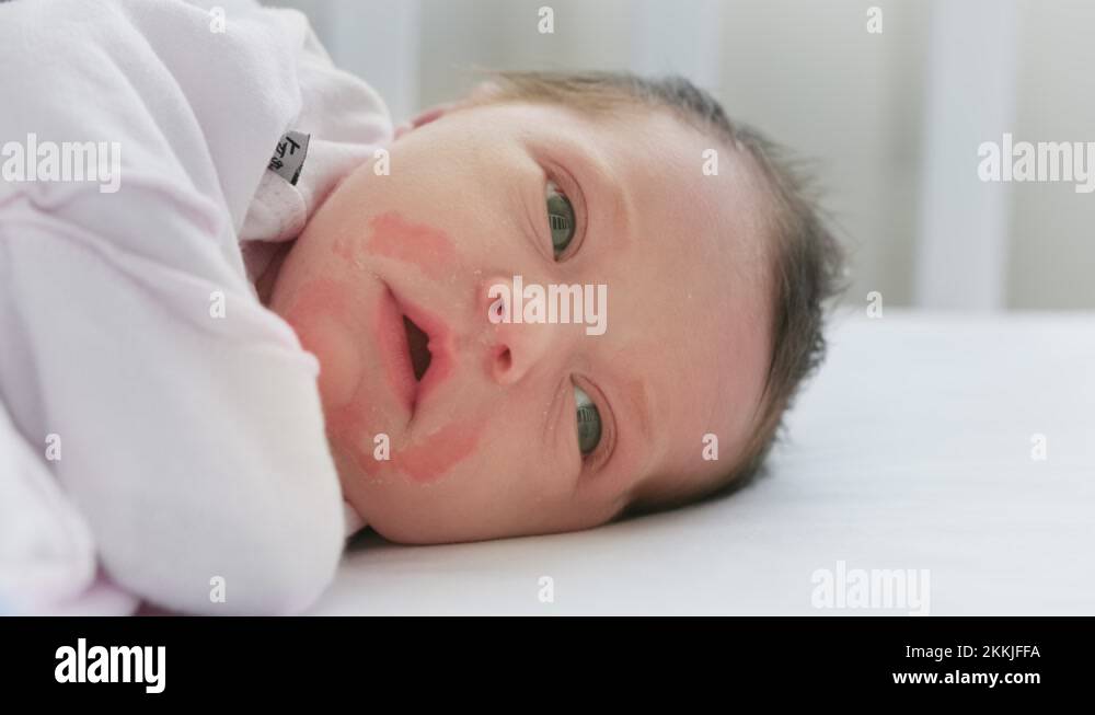 diaper-rash-skin-stock-videos-footage-hd-and-4k-video-clips-alamy