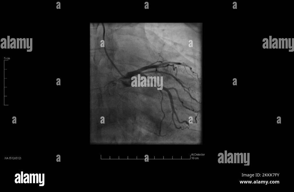 Angioplasty x ray Stock Videos & Footage HD and 4K Video Clips Alamy