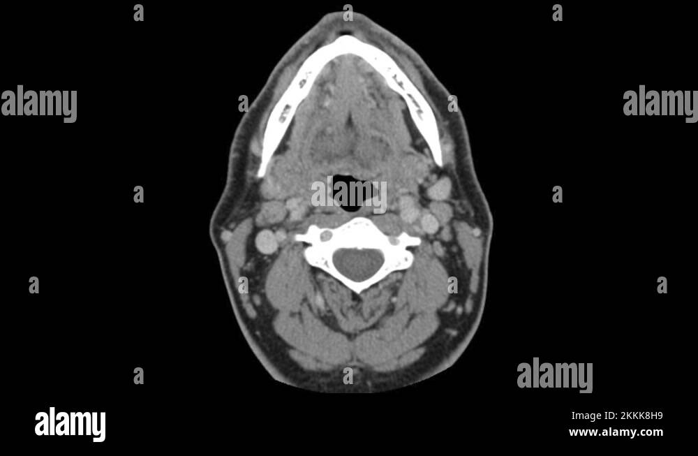 Axial CT Computed Tomography scan layers of head and chest, no text ...