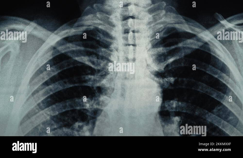 Chest x ray asthma Stock Videos & Footage HD and 4K Video Clips Alamy