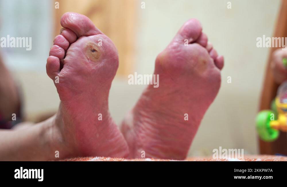 Treatment of diabetic foot ulcer. Old woman feet damage. Blood glucose