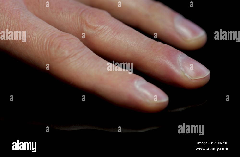 Black skin swollen hand Stock Videos & Footage HD and 4K Video Clips