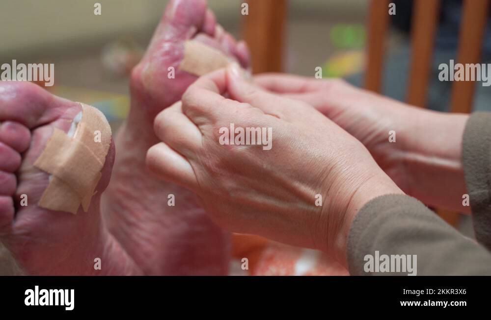 Treatment of diabetic foot ulcer. Old woman feet damage. Blood glucose