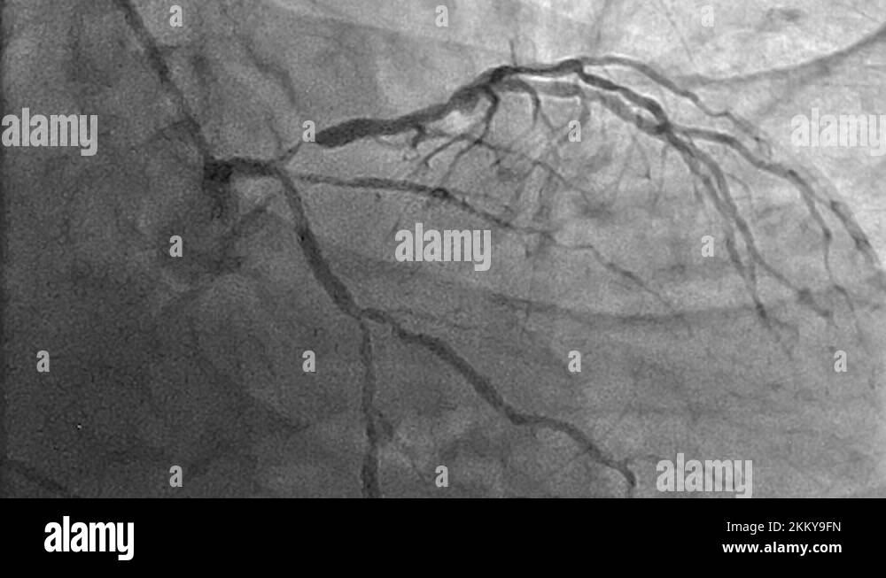 Cardiology x ray patient heart Stock Videos & Footage HD and 4K Video