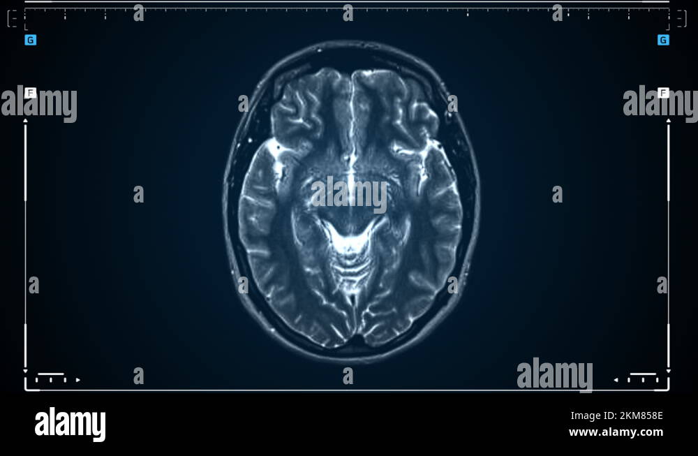 Brain MRI scan. Scanning of brain's resonance image