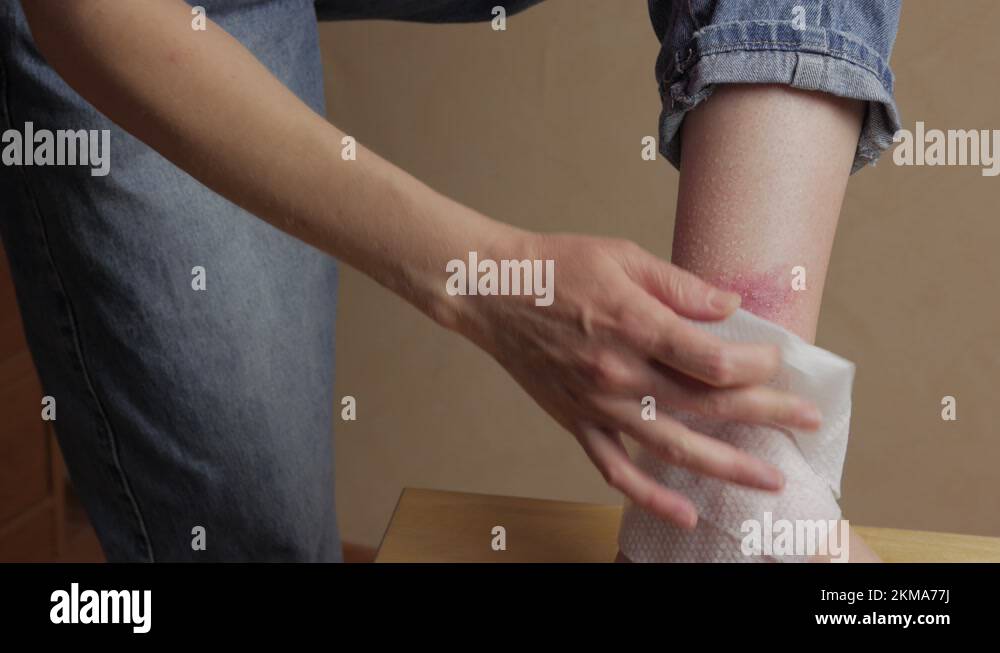 Closeup of an abscess from an insect bite on a woman's leg. A woman