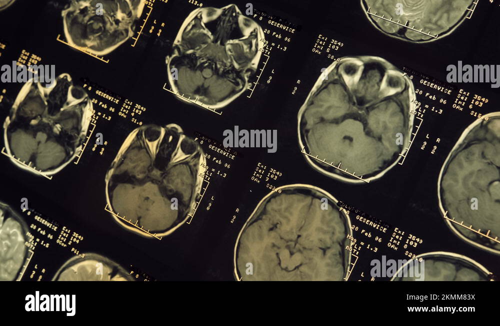 Magnetic resonance imaging (mri) of the human brain. Closeup. Macro ...