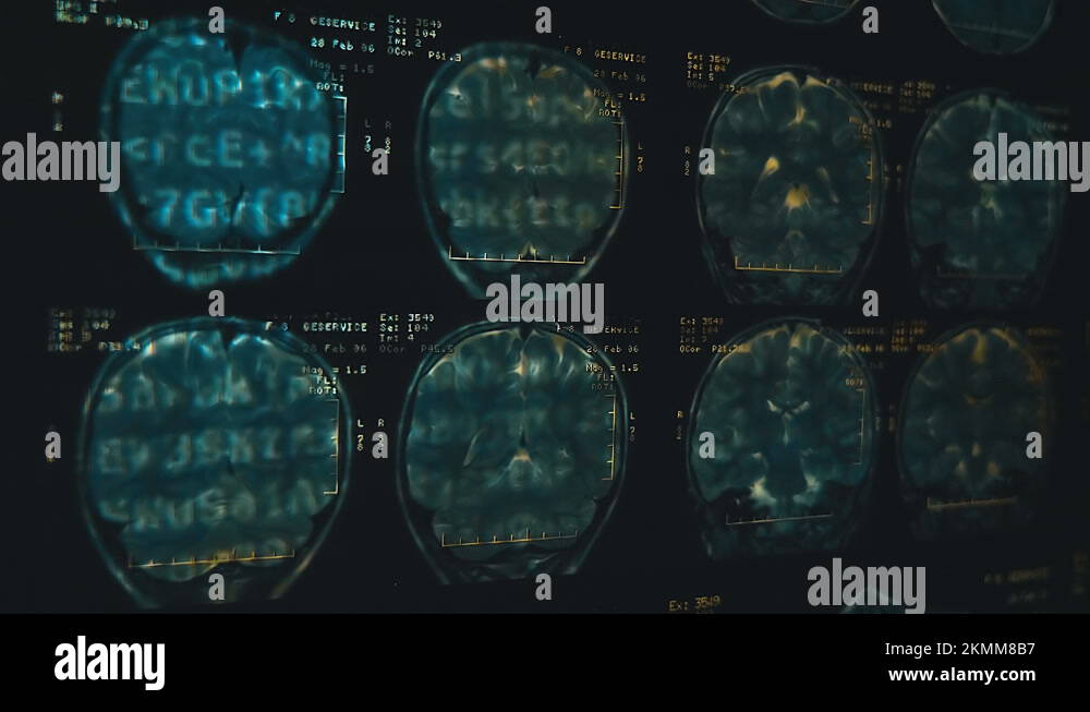 Magnetic resonance imaging (mri) of the human brain. Closeup. Macro ...