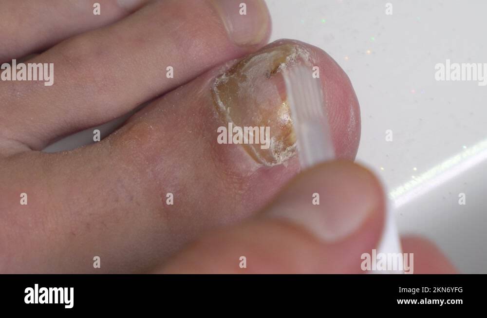 Mycosis On Big Toe Nail Treatment With Medicated Antifungal Nail Polish Stock Video Footage Alamy