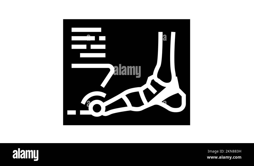 xray radiograph of foot gout diesase glyph icon animation Stock Video