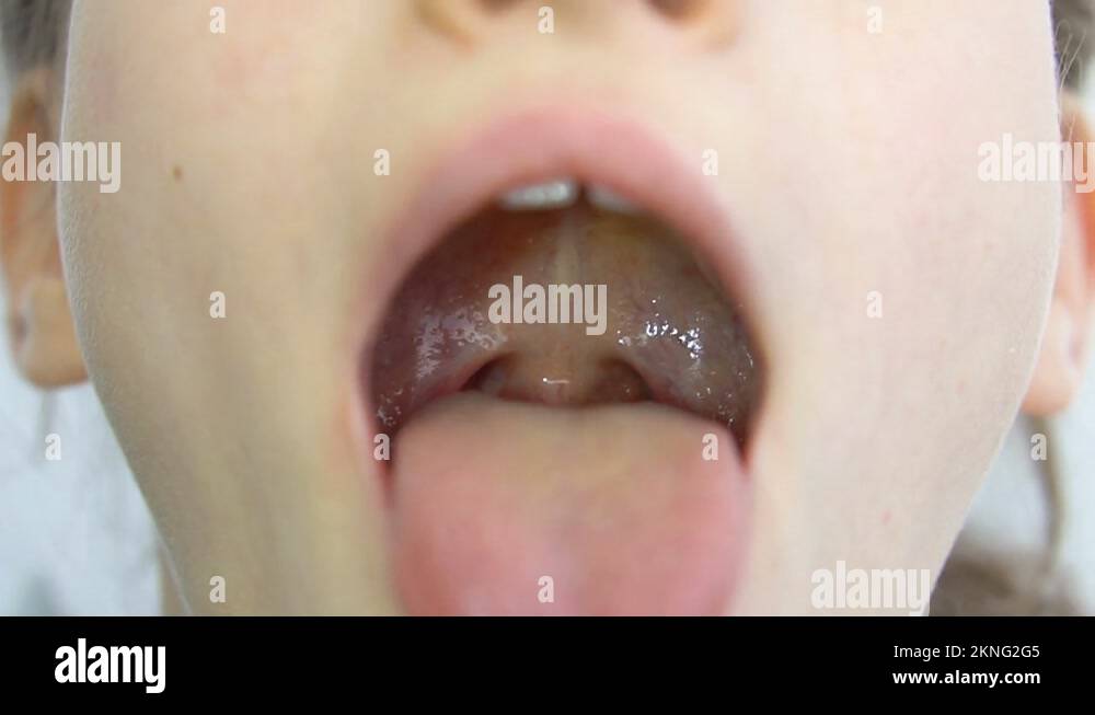 Wide open mouth with a tongue stuck out, view of the uvula and the soft