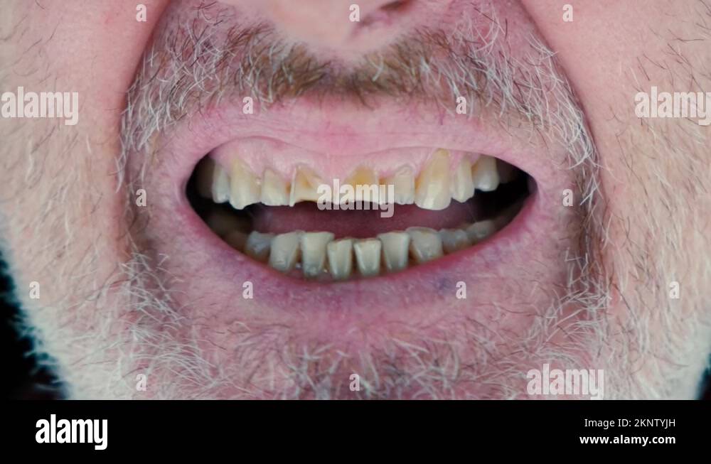 Crooked teeth adult Stock Videos & Footage - HD and 4K Video Clips - Alamy