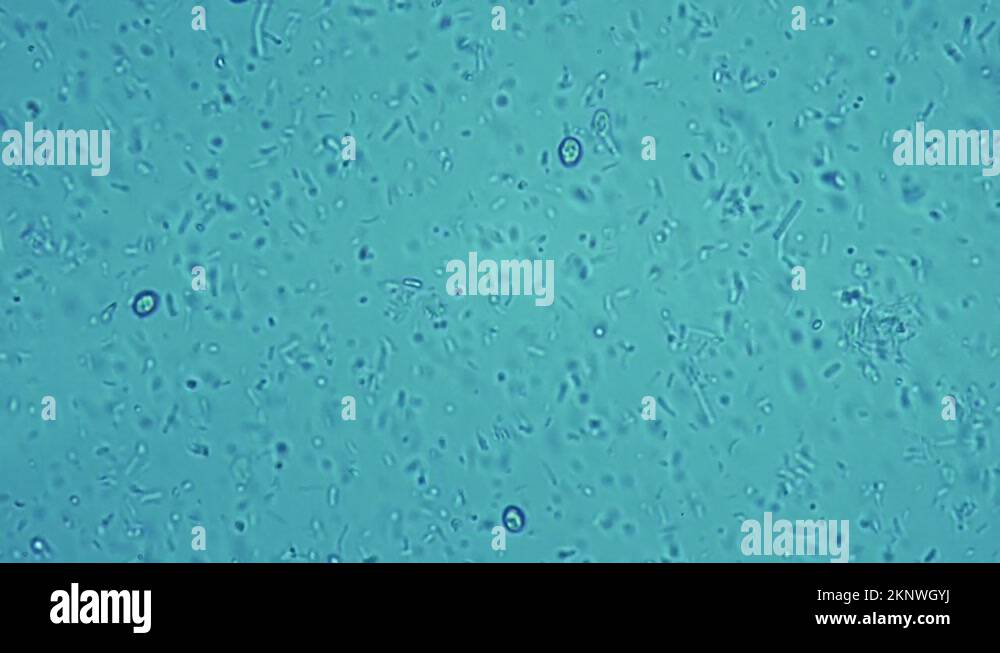 Tetanus lockjaw Stock Videos & Footage - HD and 4K Video Clips - Alamy