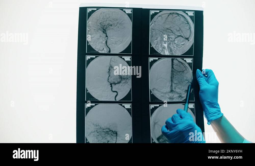 Xray, resonance image of head. Doctor examining blood vessels