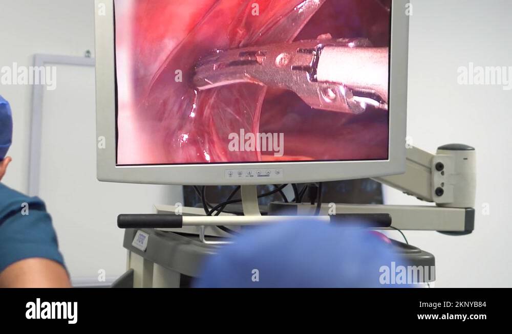 Gallbladder operation Stock Videos & Footage HD and 4K Video Clips