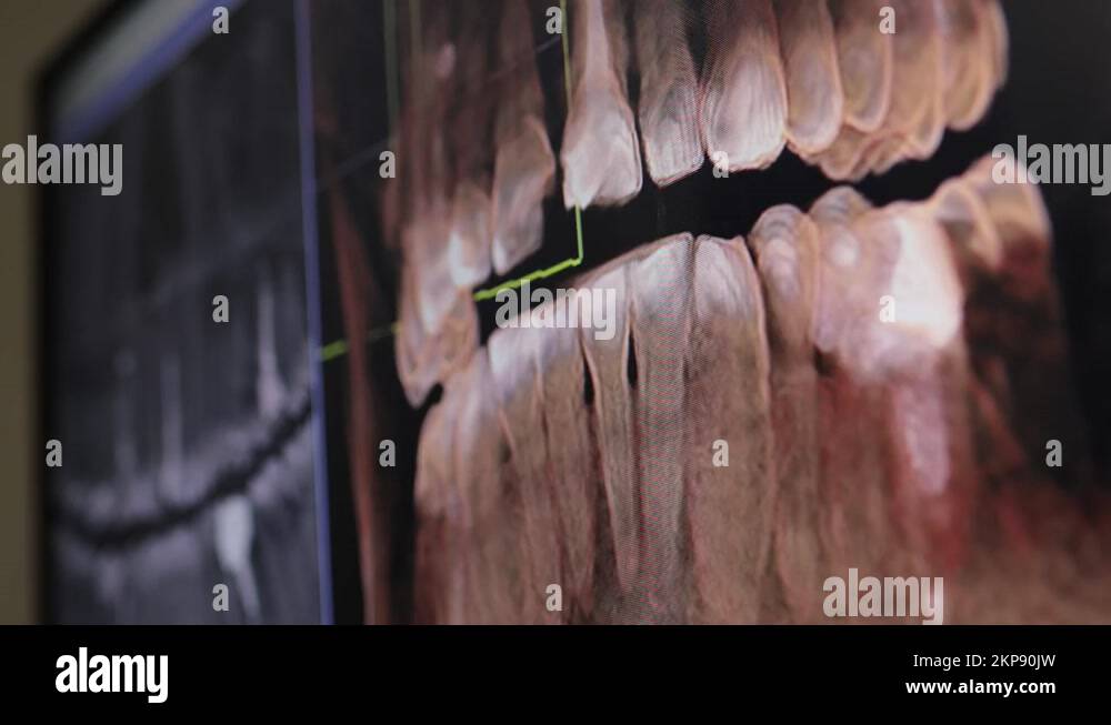 3D xray of jaw teeth. Fillings, a crown, sealed canals of the tooth