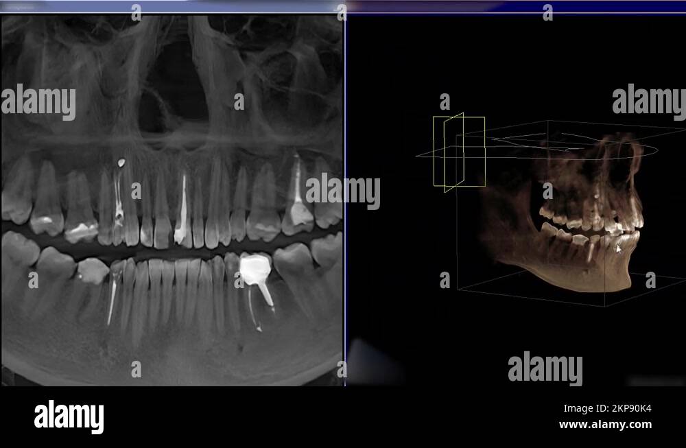 3D xray of jaw teeth. Fillings, a crown, sealed canals of the tooth