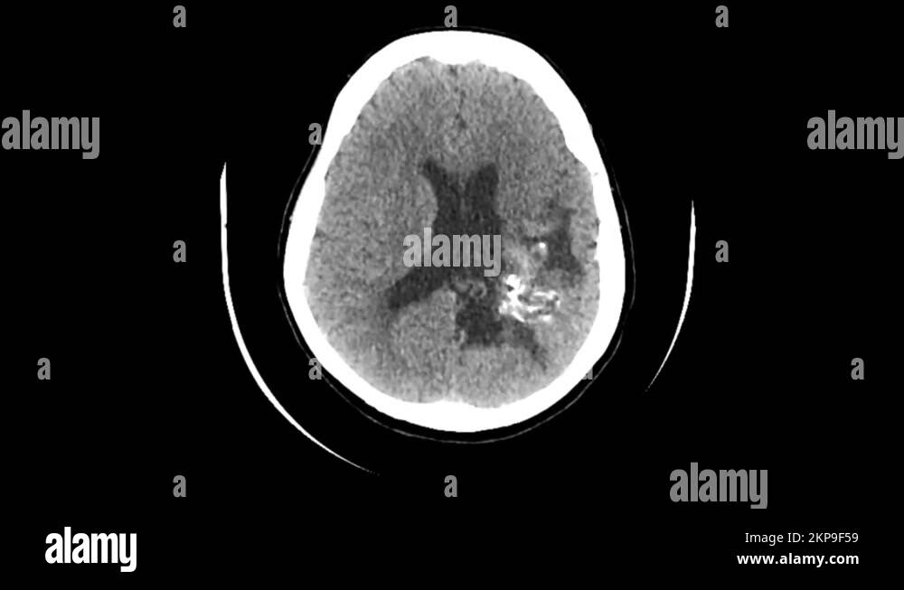 Softening Of The Brain Stock Videos Footage HD And 4K Video Clips ppt-hardness-of-water-powerpoint-presentation-id-2956417