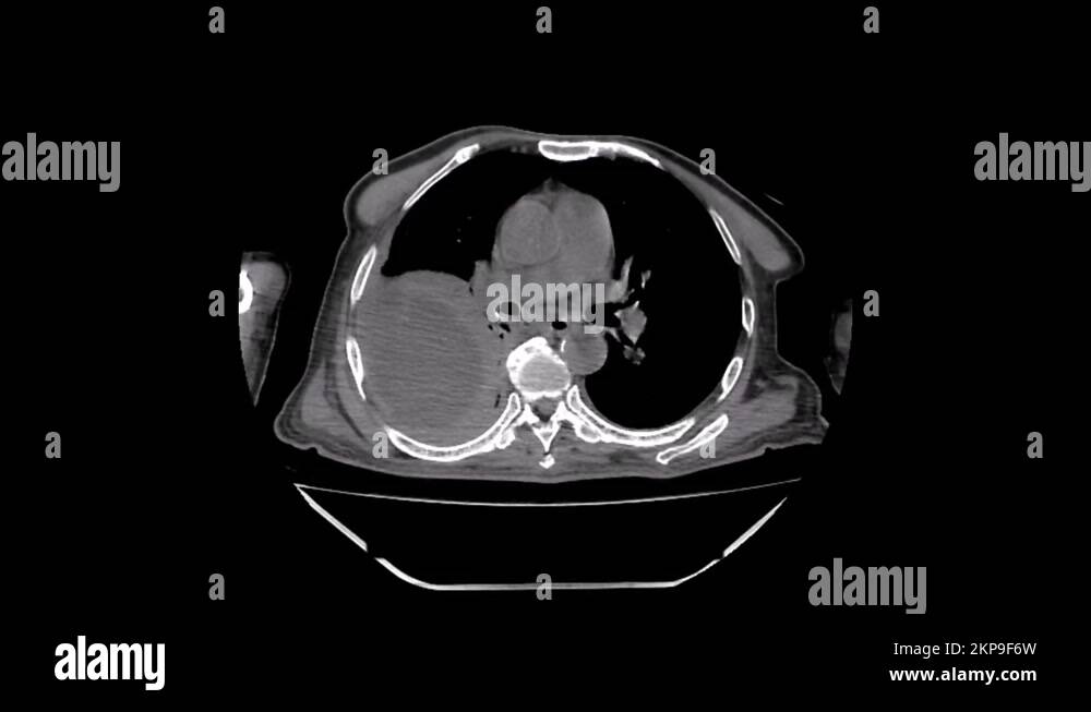 Pleural Effusion And Empyema Ct Scan Stock Video Footage Alamy 9951