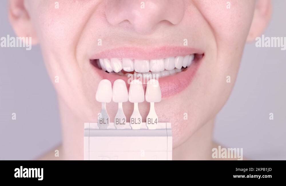 Perfect white teeth close up with shade guide bleach color, female