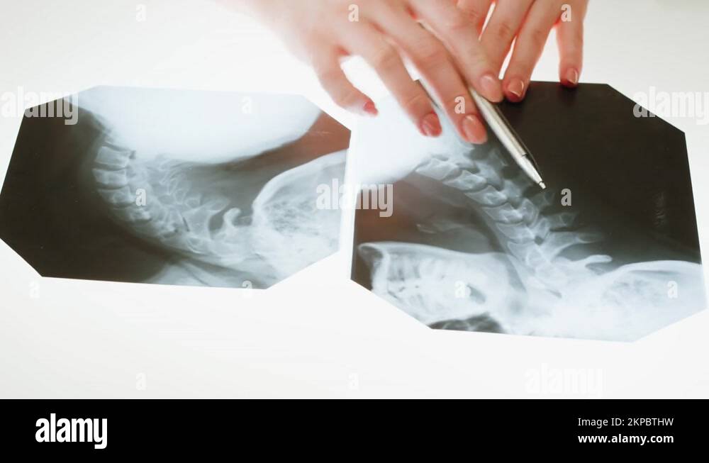 X rays cervical Stock Videos & Footage - HD and 4K Video Clips - Alamy