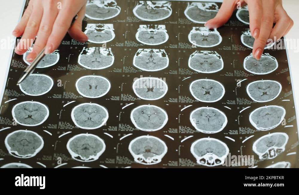 Xray, resonance image of head, human brain MRI closeup