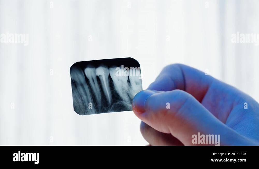 Teeth xray closeup. Doctor examining xray of tooth,