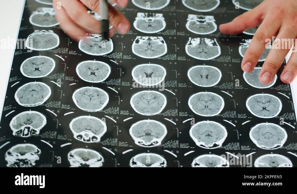 Xray, resonance image of head, human brain MRI closeup
