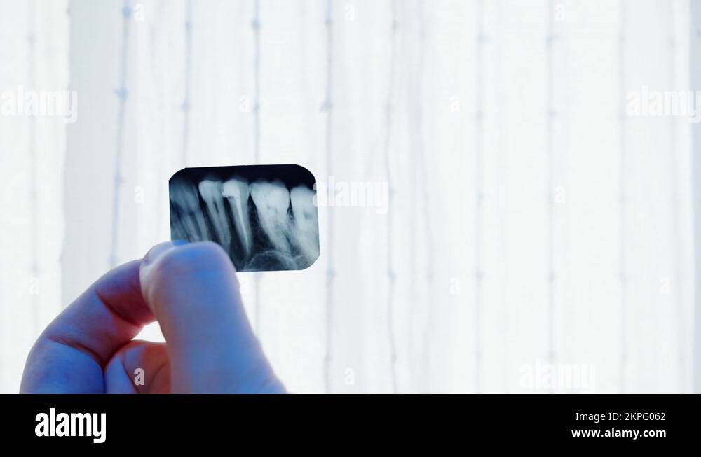 Teeth xray closeup. Doctor examining xray of tooth,