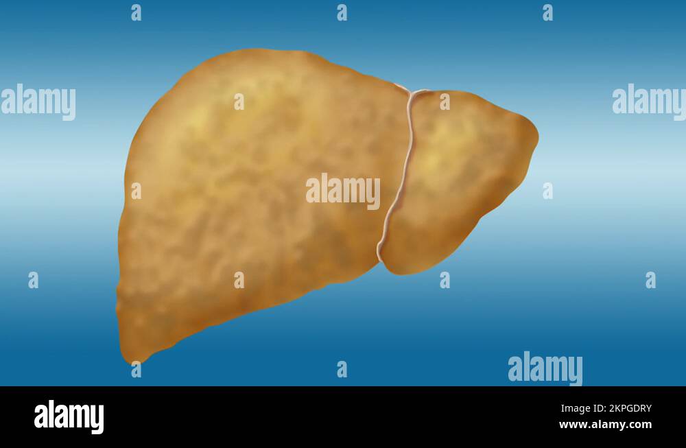 Cirrhosis Stock Videos & Footage HD and 4K Video Clips Alamy
