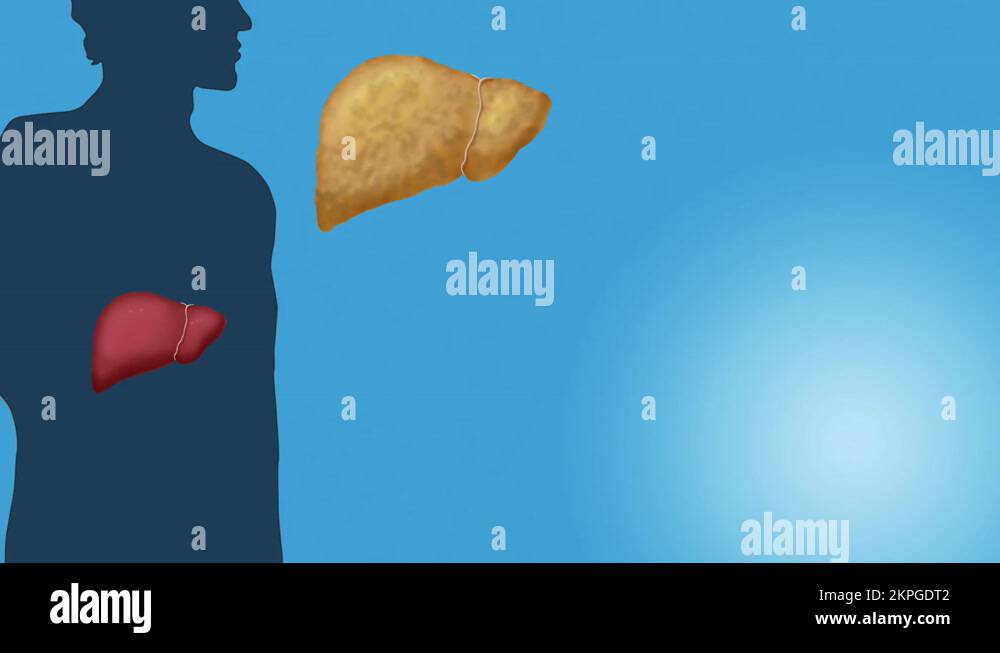 Person with liver disease Stock Videos & Footage HD and 4K Video