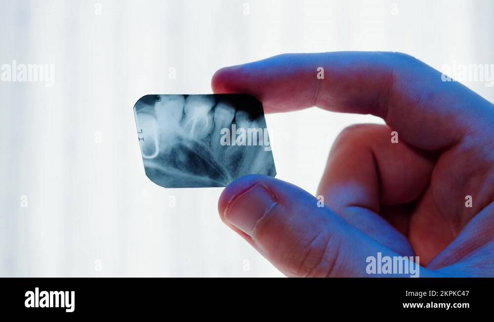 Teeth xray closeup. Doctor examining xray of tooth,