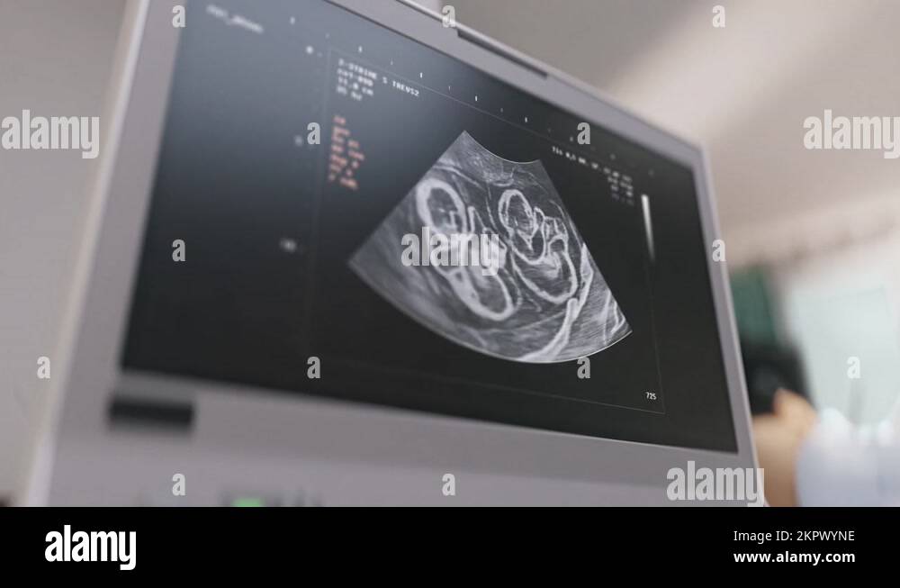 Sonogram twins Stock Videos & Footage HD and 4K Video Clips Alamy