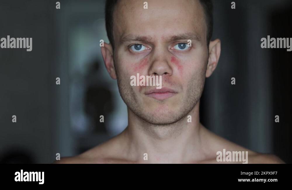 allergic reaction on the face man, symptoms of urticaria autoimmune